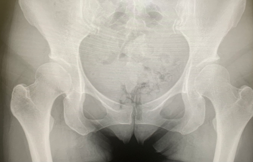 Hip Dysplasia — Frisco Texas Orthopedic Surgeon and Sports Medicine