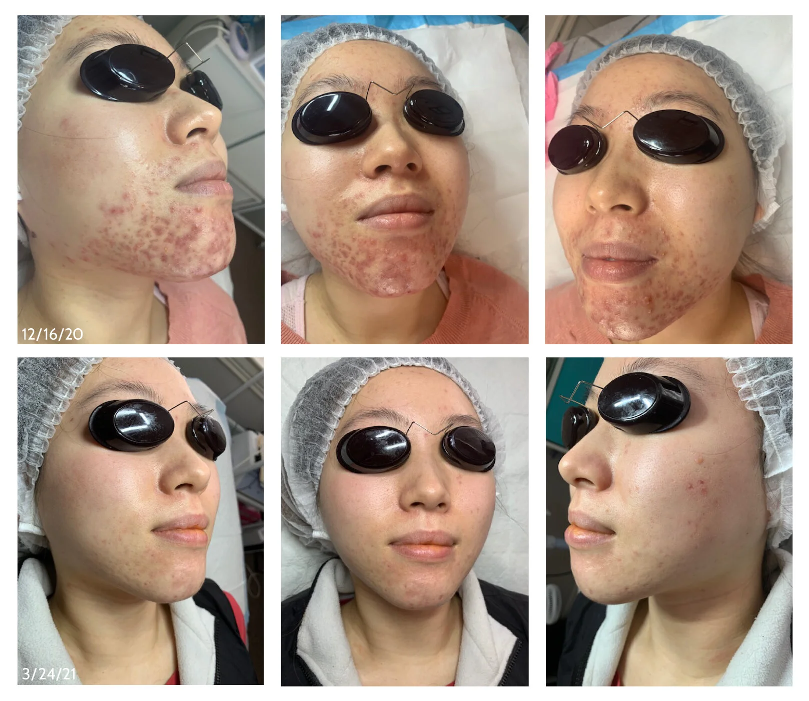 clear beauty acne clinic