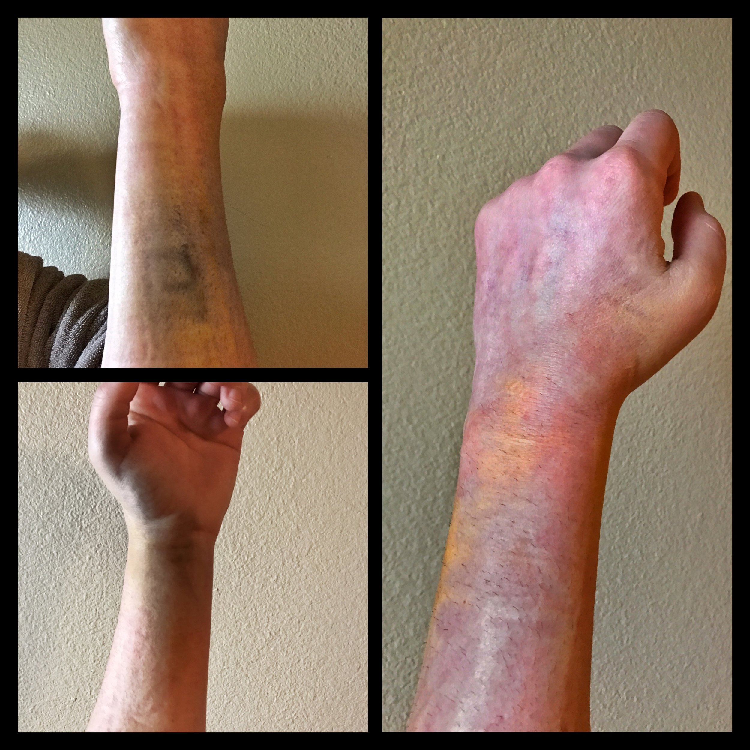 bruising and inflammation 3 days after