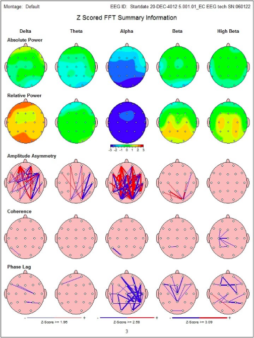 The top row reflects the absolute power in frequencies at each site. For example, in the upper middle there is an area of blue, reflecting decreased activity in the Alpha brain frequencies. This is associated with problems in multitasking and day to day functioning. In the second row there is an area of orange in the Delta frequencies, which reflects problems with sleep and issues with depression and chronic pain. The middle row is not routinely utilized in this clinic. The fourth and fifth rows show a bunch of lines, each indicating the connections not working together. This is associated with reduced cognitive efficiency, commonly seen post-trauma. There is no other instrument on the market that can empirically do this.