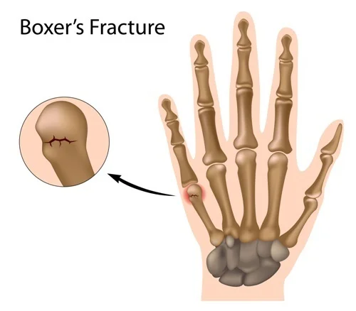 shutterstock_MTfracture.jpg
