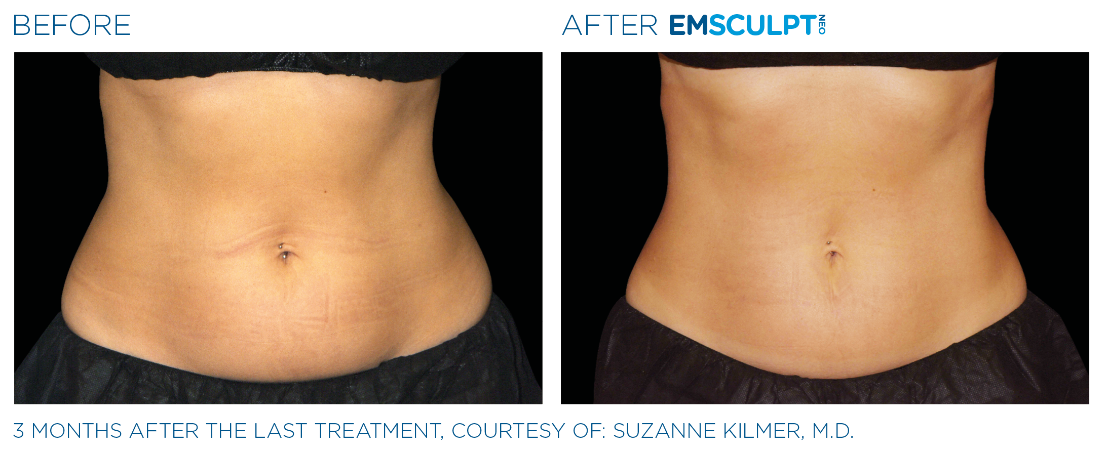 Emsculpt_Neo_PIC_Ba-card-female-lateral-abdomen-175_ENUS100.png