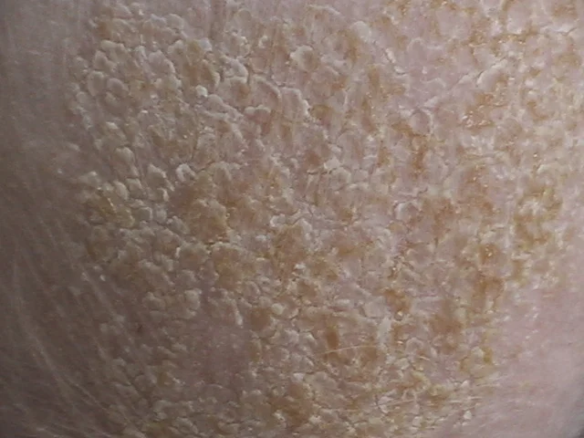Cradle_Cap_Detail.jpg
