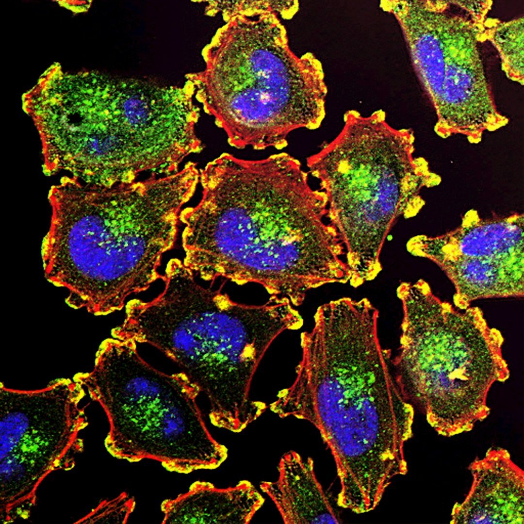 Blood Cancers: Holistic Care for Wellbeing in New Zealand