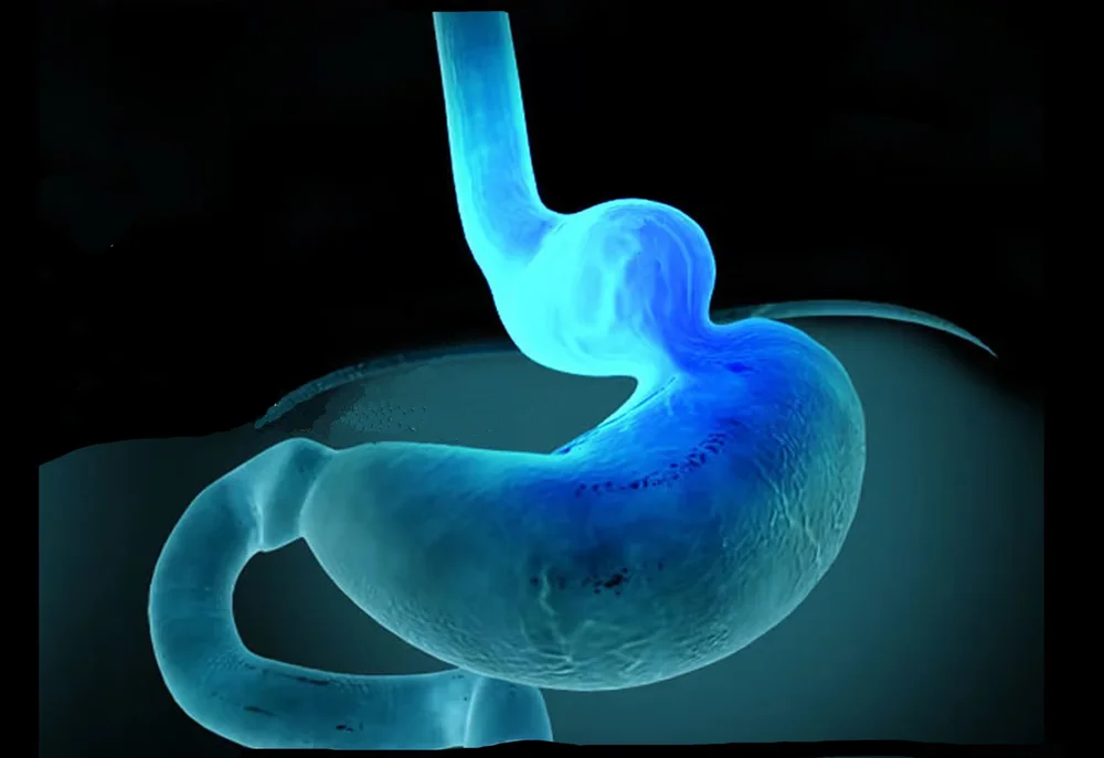 Hiatal Hernia Repair — New Me For Life