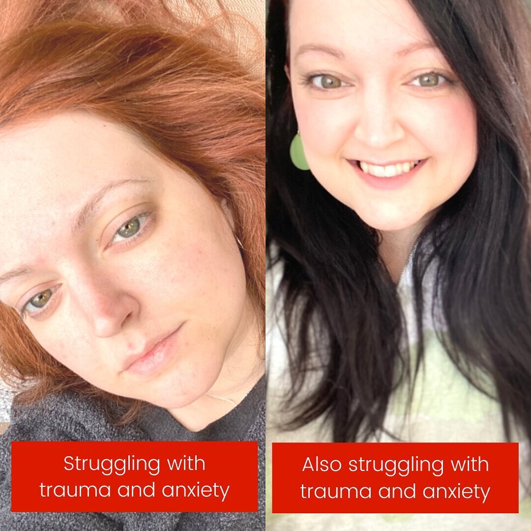 You don&rsquo;t know the full picture when you look at me.

On the left, I was fresh out of the emergency room because of my anxiety, trying to process my trauma and failing to understand what I could do to heal. I couldn&rsquo;t hide what was happen