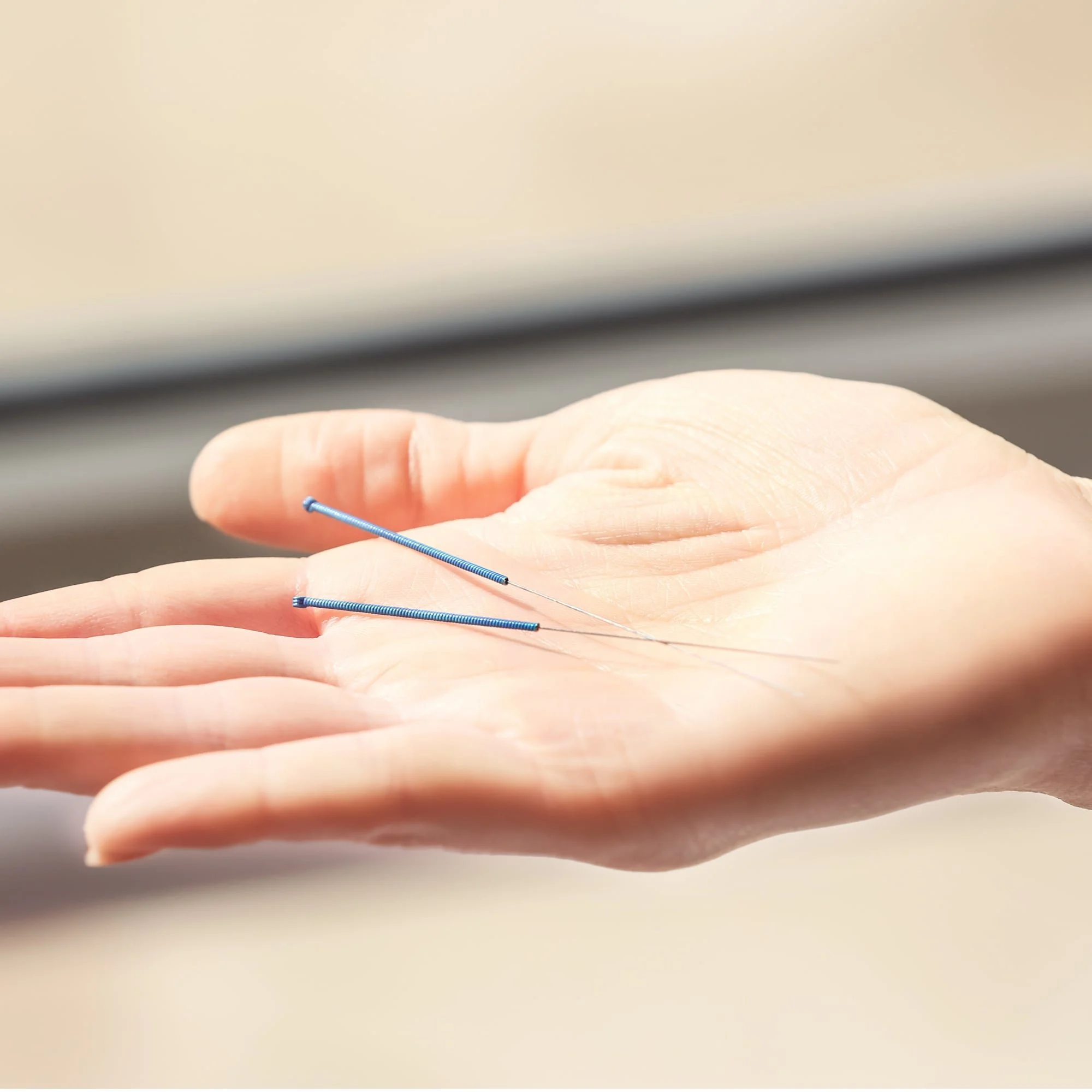 Acupuncture for stress and Anxiety