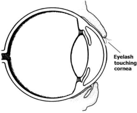 Eyelash touching Cornea causing irritation