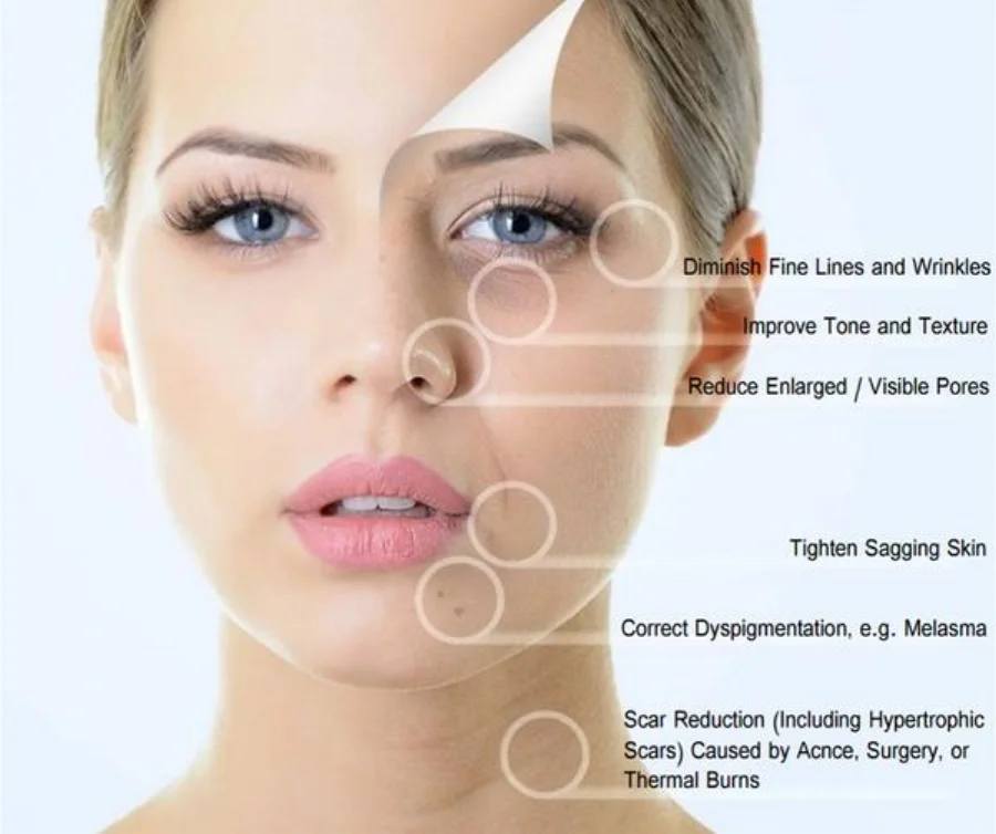 Microneedling.jpg