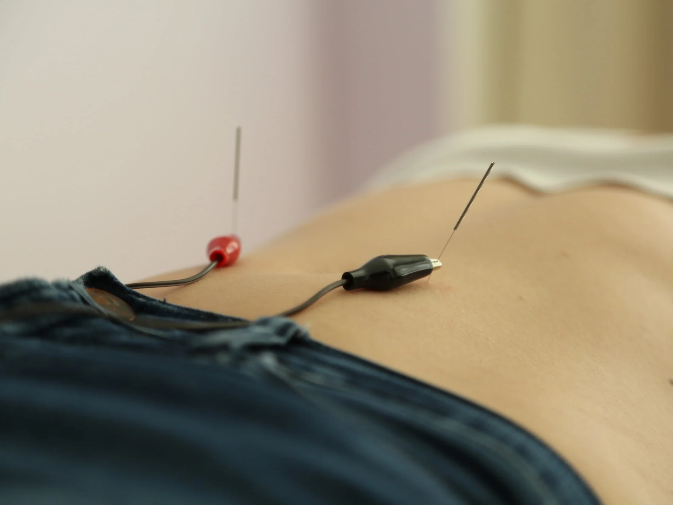electroacupuncture.jpg