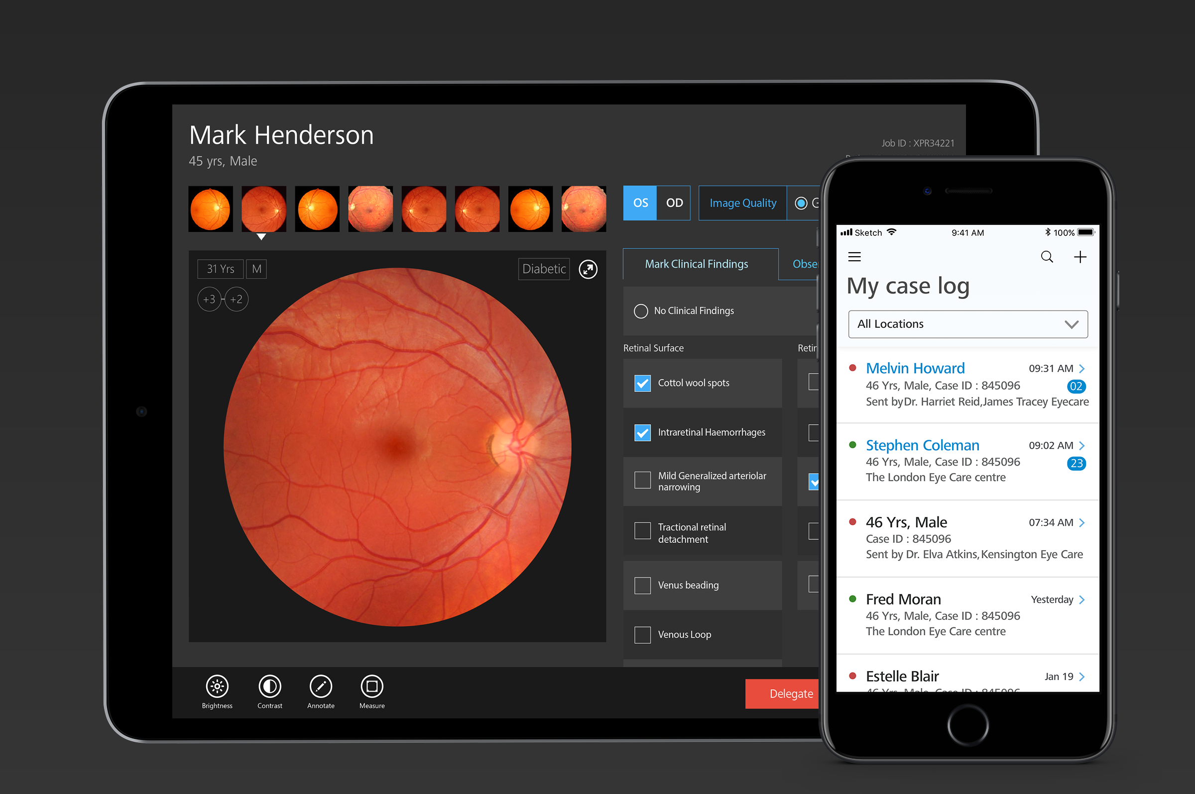 Mobile applications for doctors to screen patients for Diabetic retinopathy and other retinal problems