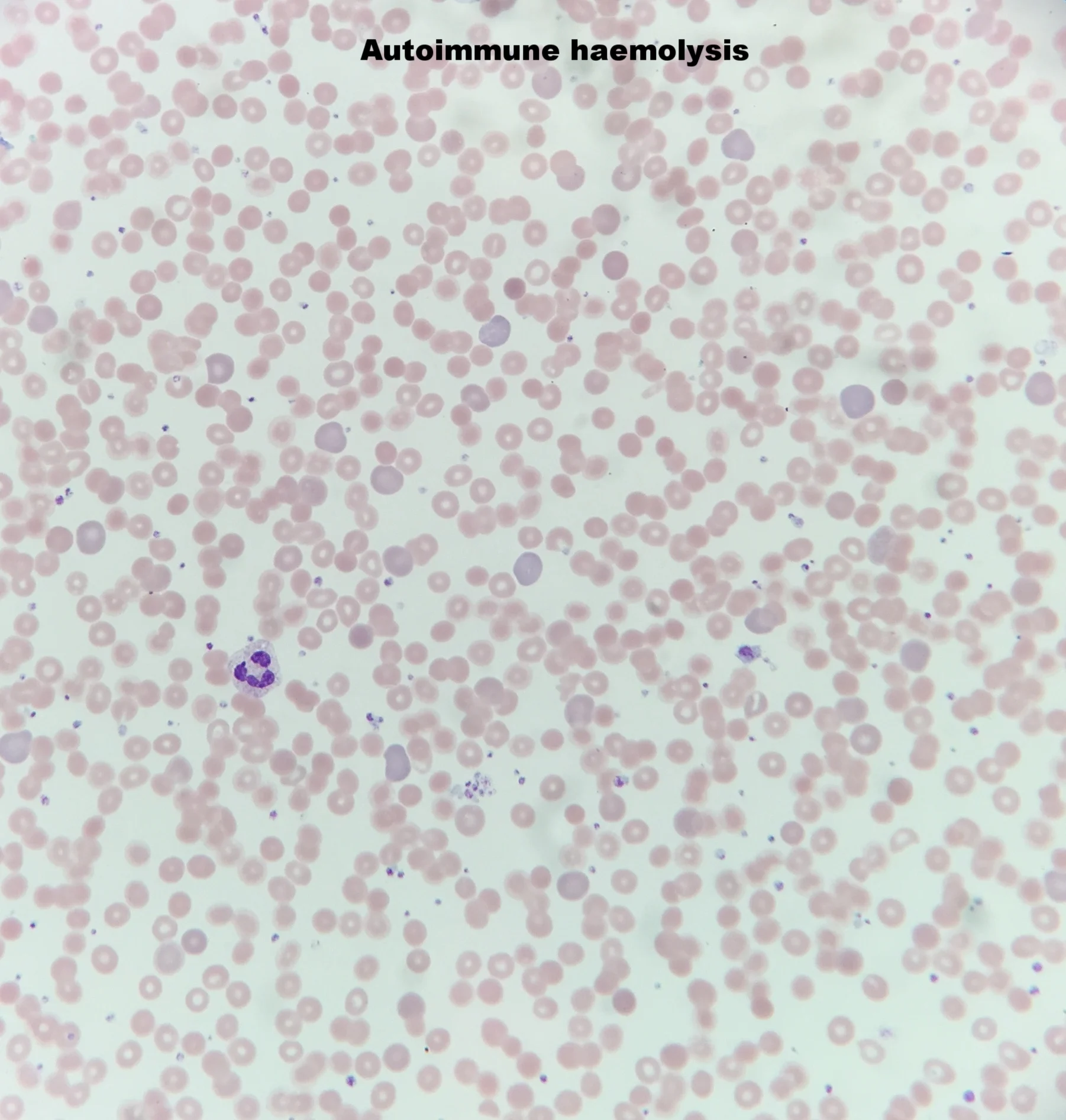 Autoimmune Haemolysis.jpg