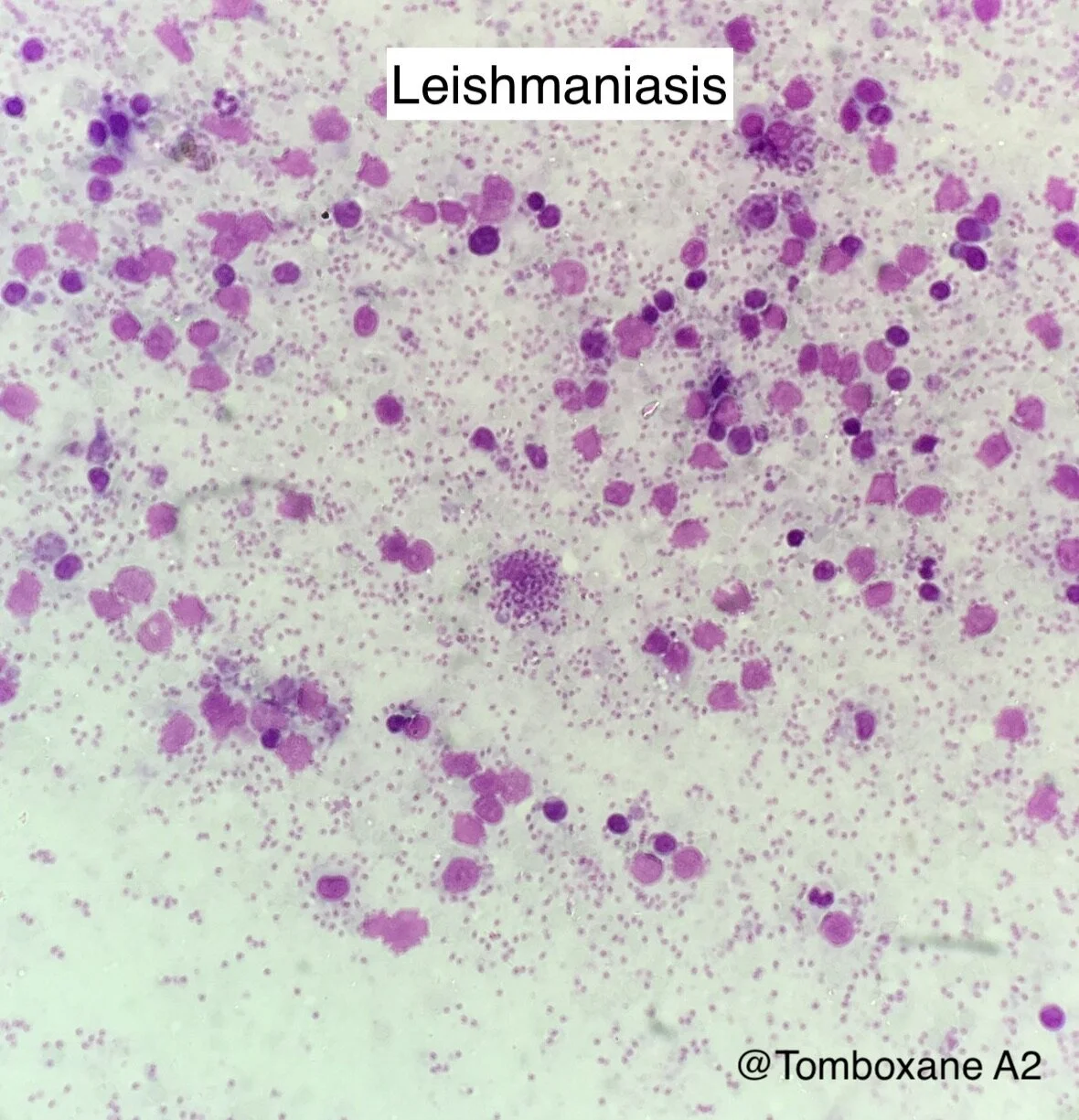 Leishmaniasis.JPG