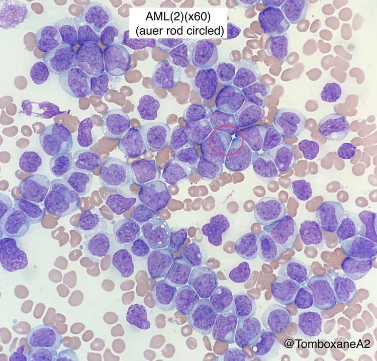 AML — HaemBase