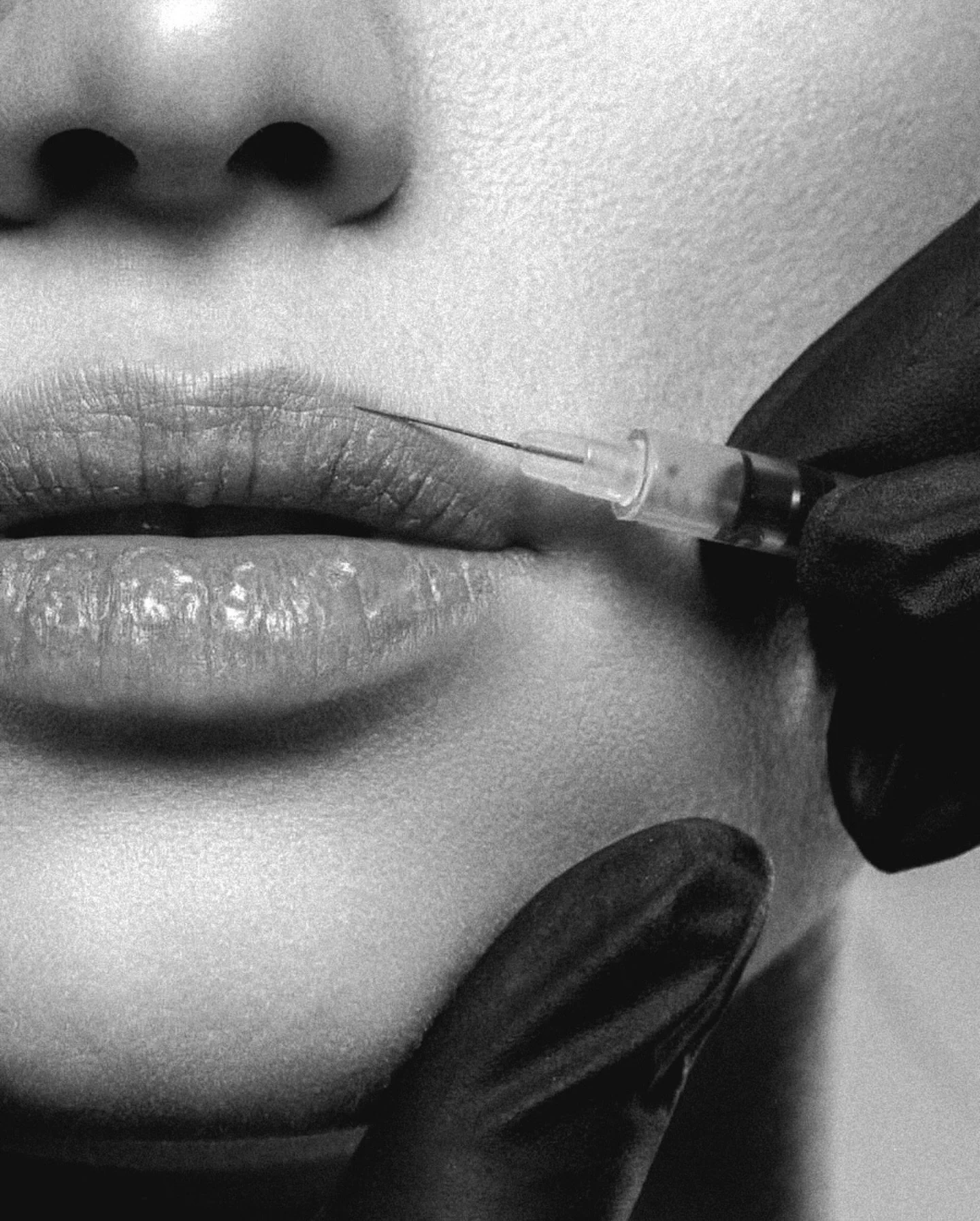 LEPPEFILLER👄💉
Vi får stadig flere spørsmål rundt leppefiller behandling, og i den anledning har vi laget litt info for alle som er nysgjerrige på denne behandlingen:
Filler er en fellesbetegnelse på et hyaluronsyre-