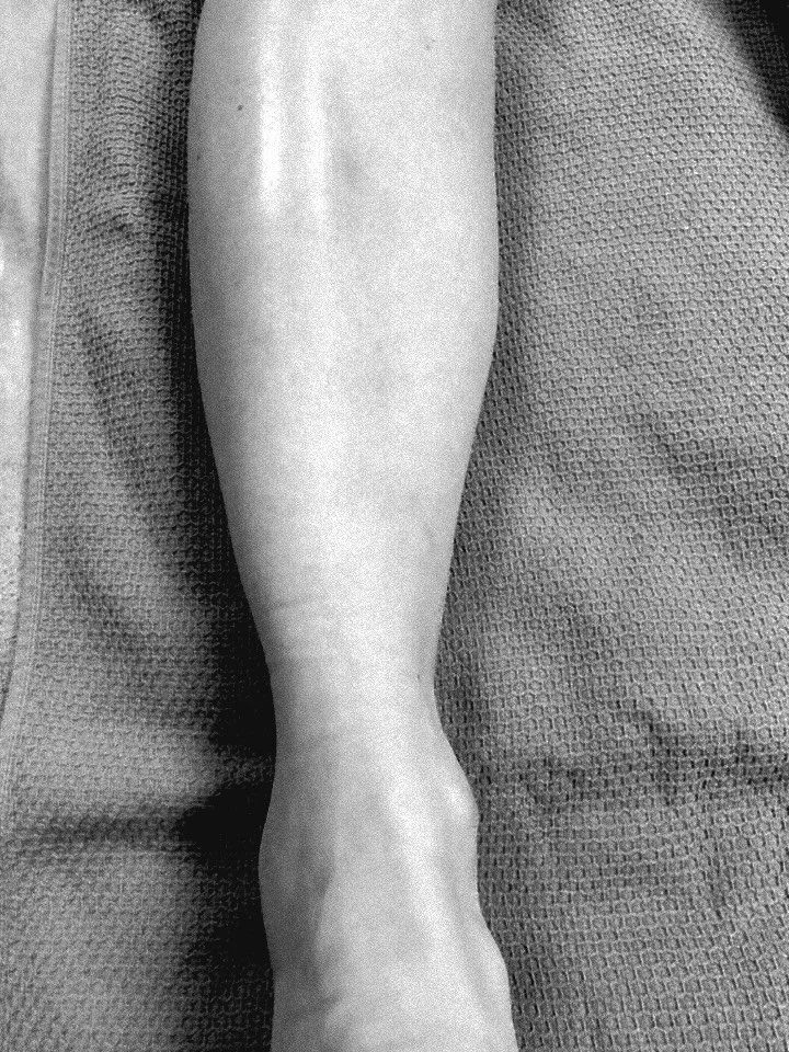 🌟4 Wave Diod Laser🌟
Vår permanente hårfjernings laser behandler alle typer hårfarger fra svart til lyst hår og den behandler alle hudtyper fra hvit til mørk hud. Ingen smerter og korte behandlingsøkter.
Effek