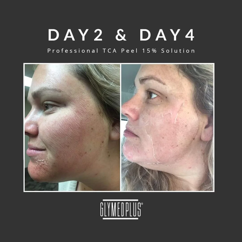 Chemical Peel S Victoria Bednar Beauty