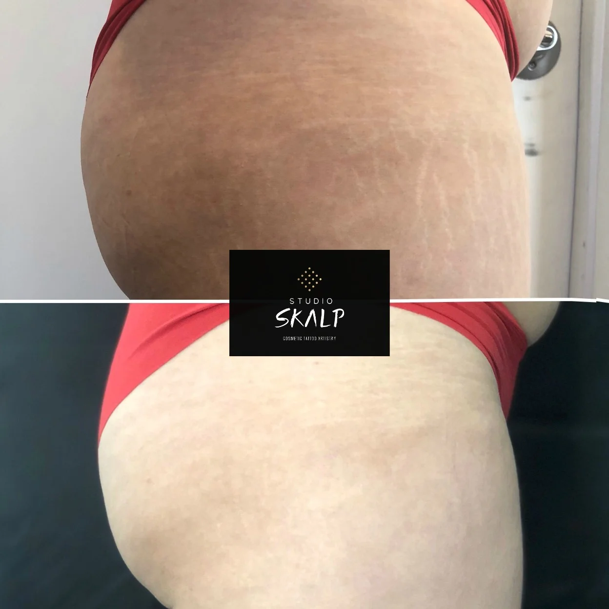 Before After Scalp Micropigmentation Scar Stretch Mark Tattoo