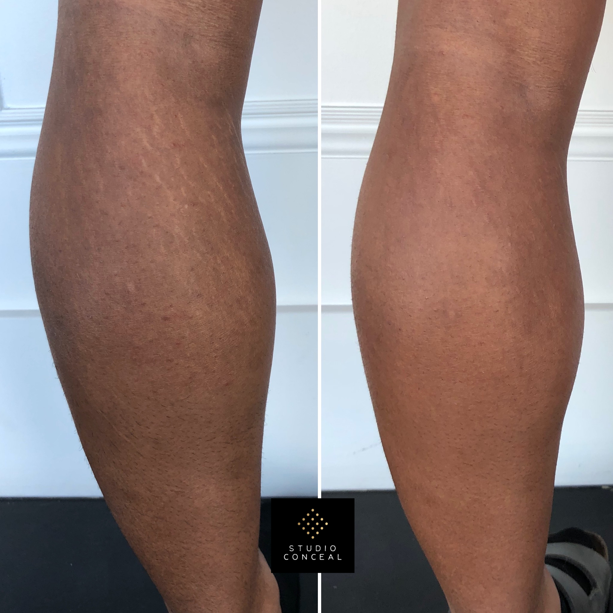 Male Stretch Mark Camouflage Tattoo