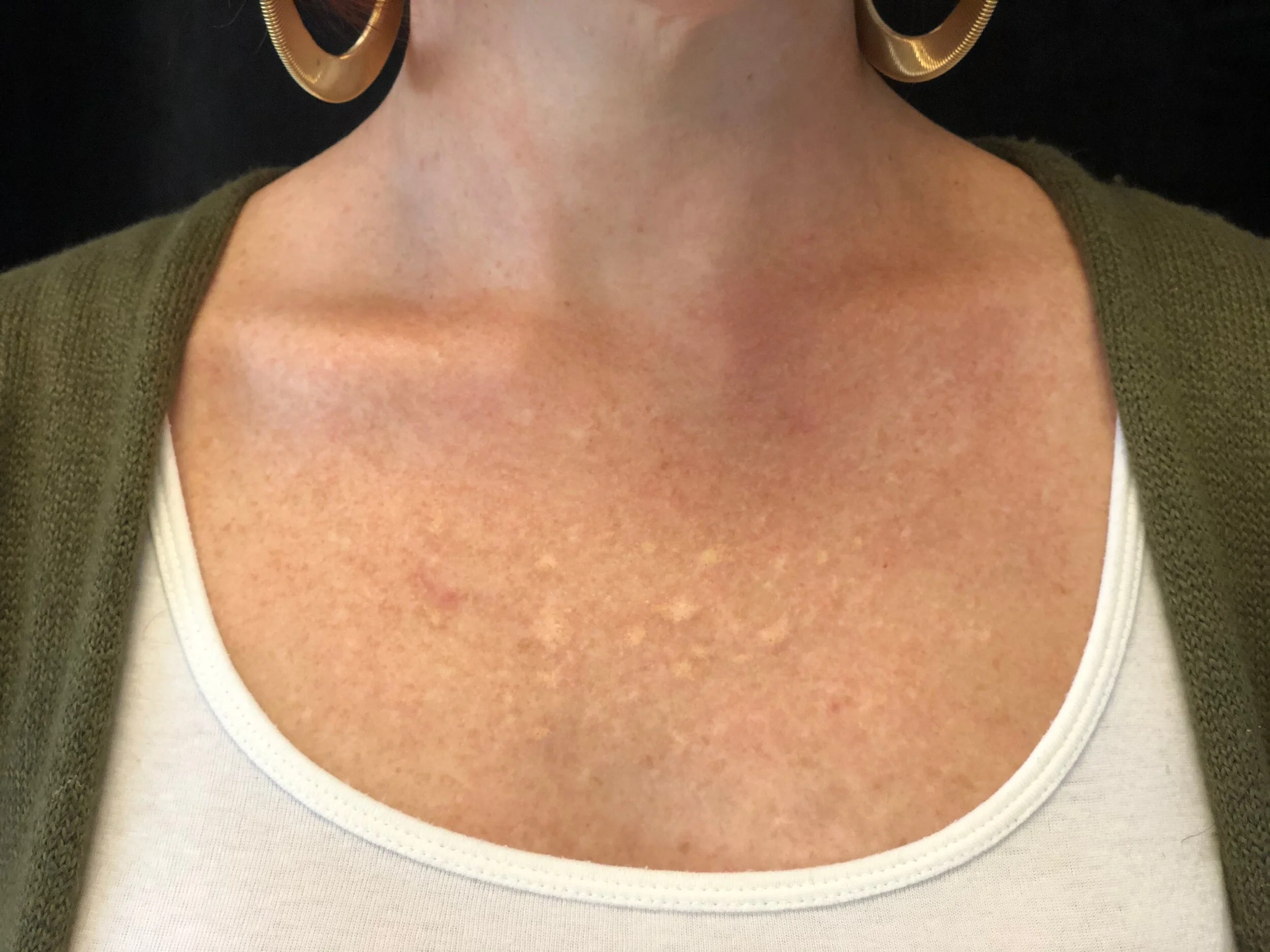 After her second session, her scar took the ink much better but it still looked “off.”
