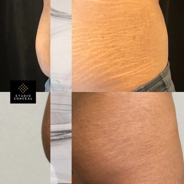 Mark's before and after stretchmark camouflage tattoo transformation