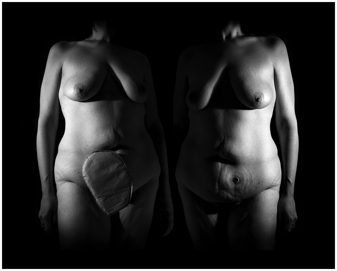 z-Rorschach Ostomy-8x10-sharp.jpg