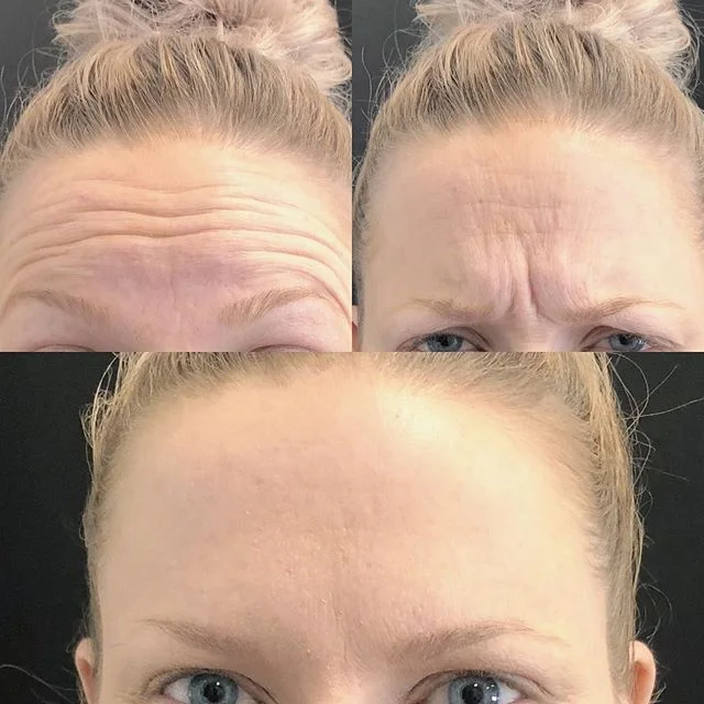 Real before-and-after results of a patients who received Botox injections at our facility.