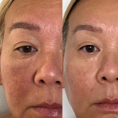 Barbara shares the results of her LED Light Therapy treatments.  The first image was taken on the 26th of February, 2019 and the second on the 29th of April, 2019. Individual results will vary.