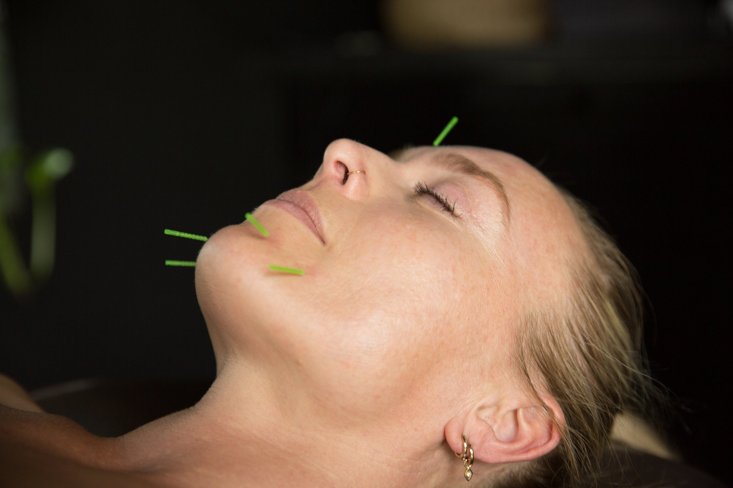 MO+ Tracy Limbrick Facial Cosmetic Rejuvenation Acupuncture.jpg