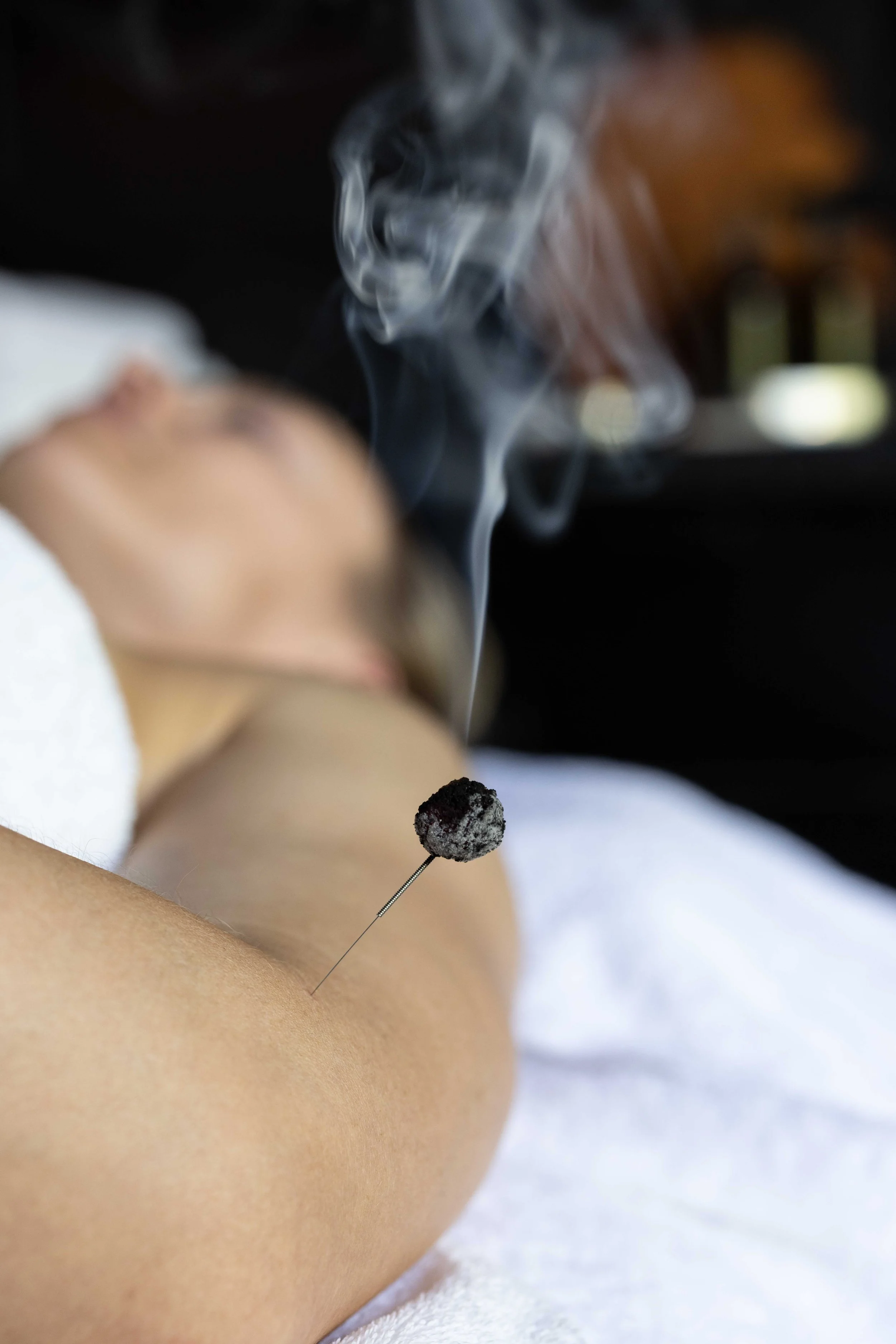 MO+ Acupuncture Bondi Junction Jeff Lee burning moxi.jpg