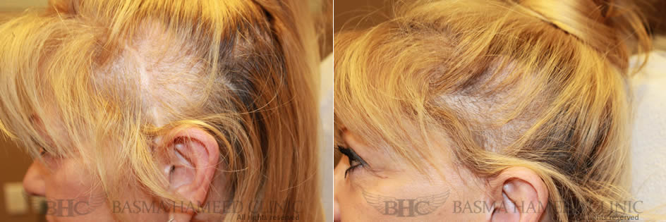 Hair Restoration — Basma Hameed Clinic