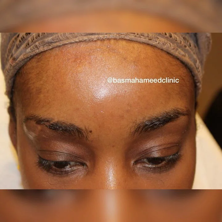 Scar Camouflage Basma Hameed Clinic