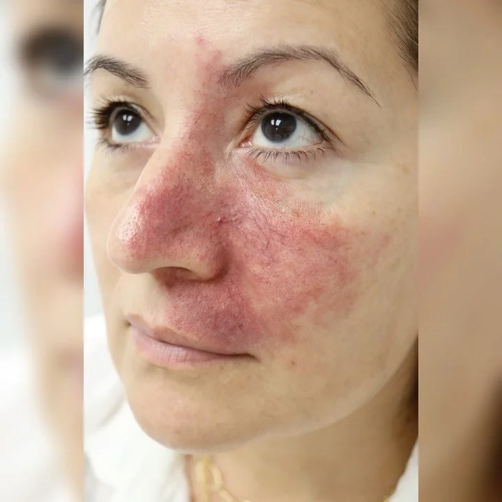 Scar Camouflage Basma Hameed Clinic