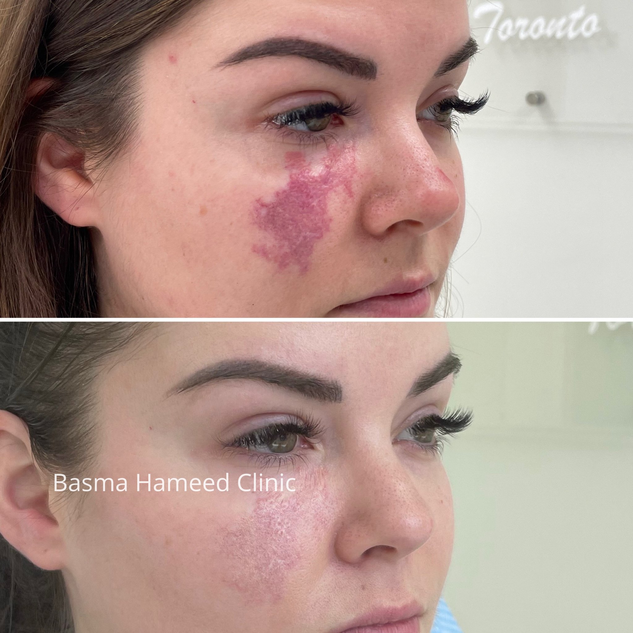 birthmark-treatment-basma-hameed-clinic
