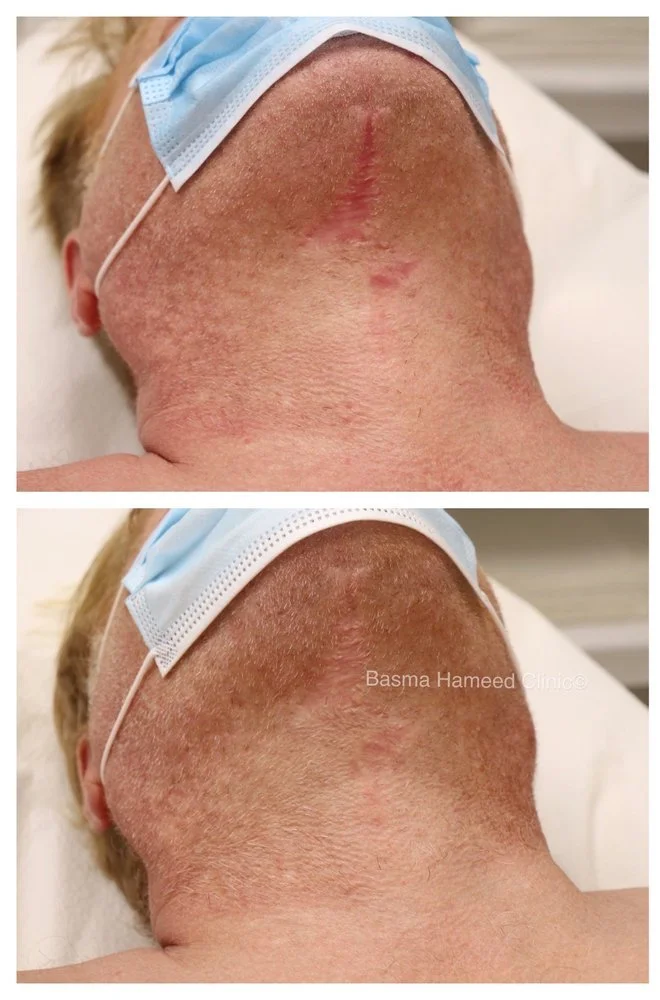 neck lift.jpeg