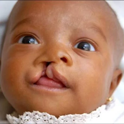 Cleft.jpg