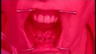 Dark electronica Synth music Close-up of a person's open mouth with dental tools and braces on the tongue.