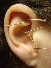 Unlocking Wellness: The Benefits of AcuDetox Auricular Acupuncture