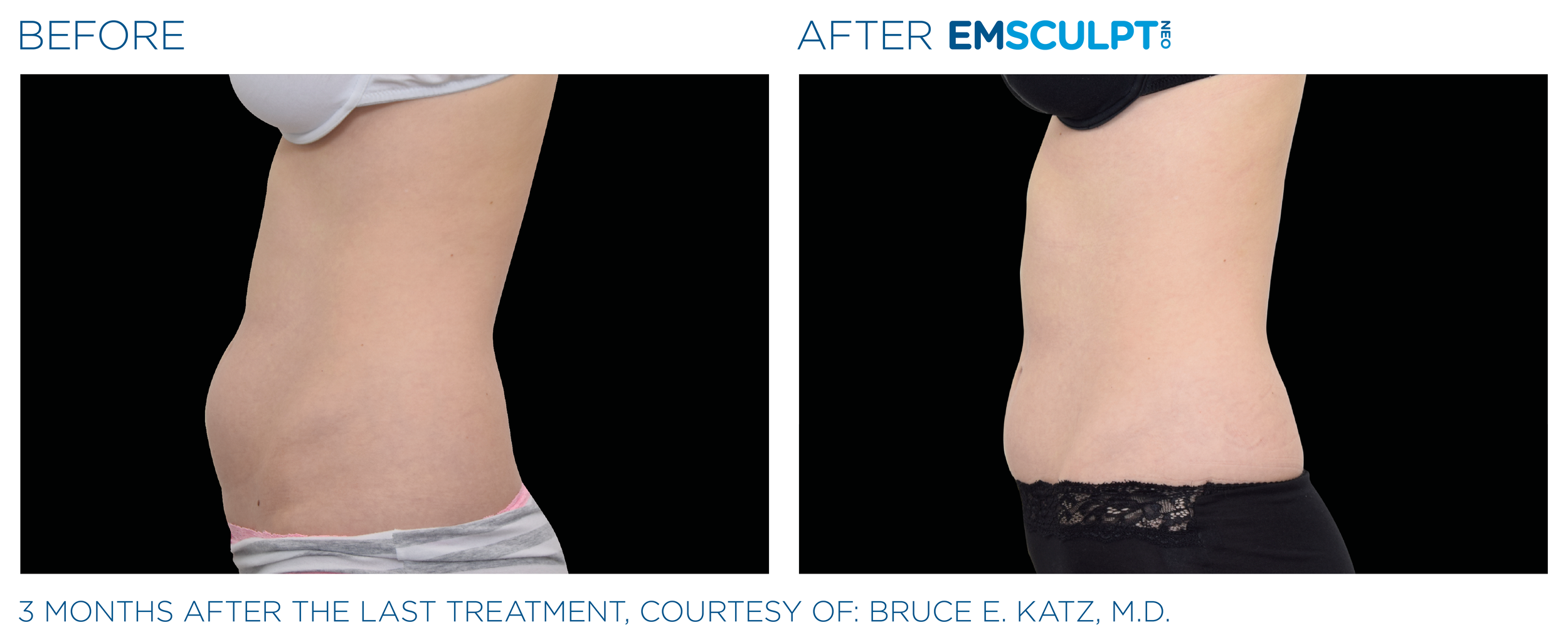 Emsculpt_neo_PIC_Ba-card-female-abdomen-024_ENUS100.png