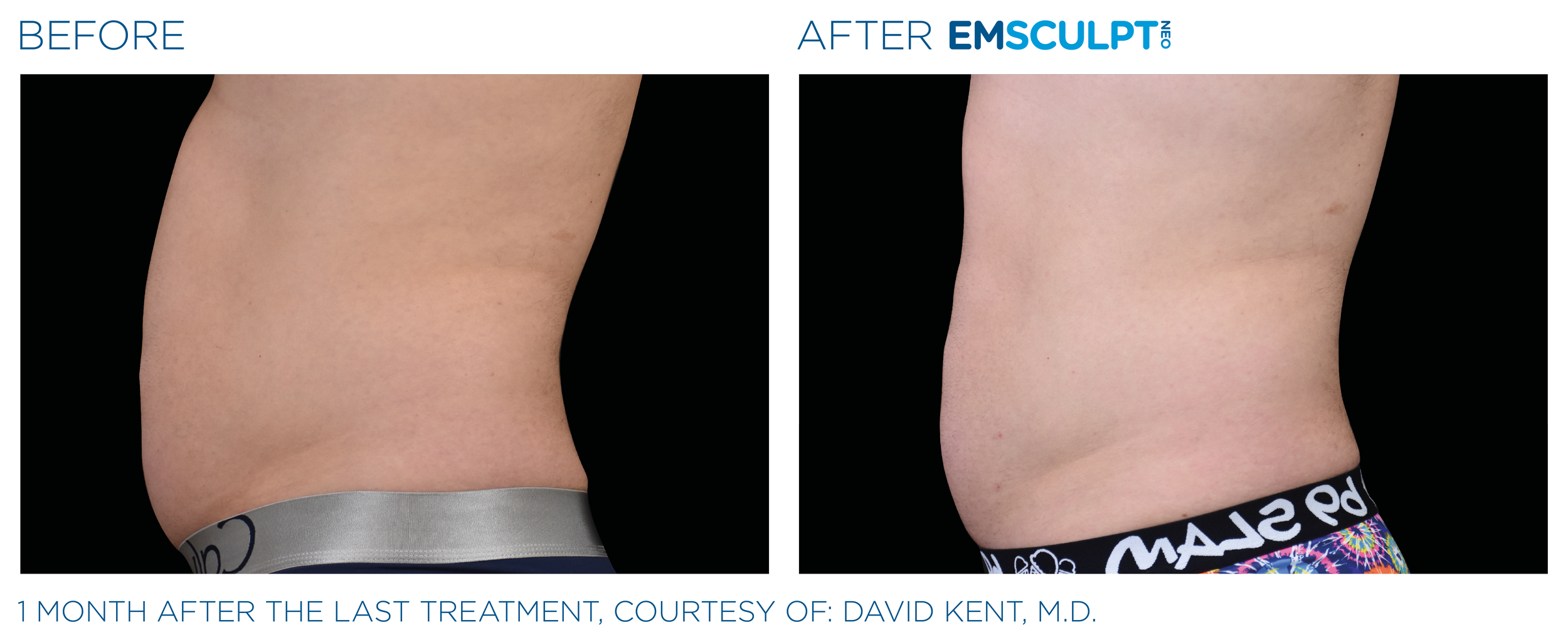 Emsculpt_neo_PIC_Ba-card-male-abdomen-014_ENUS100.png