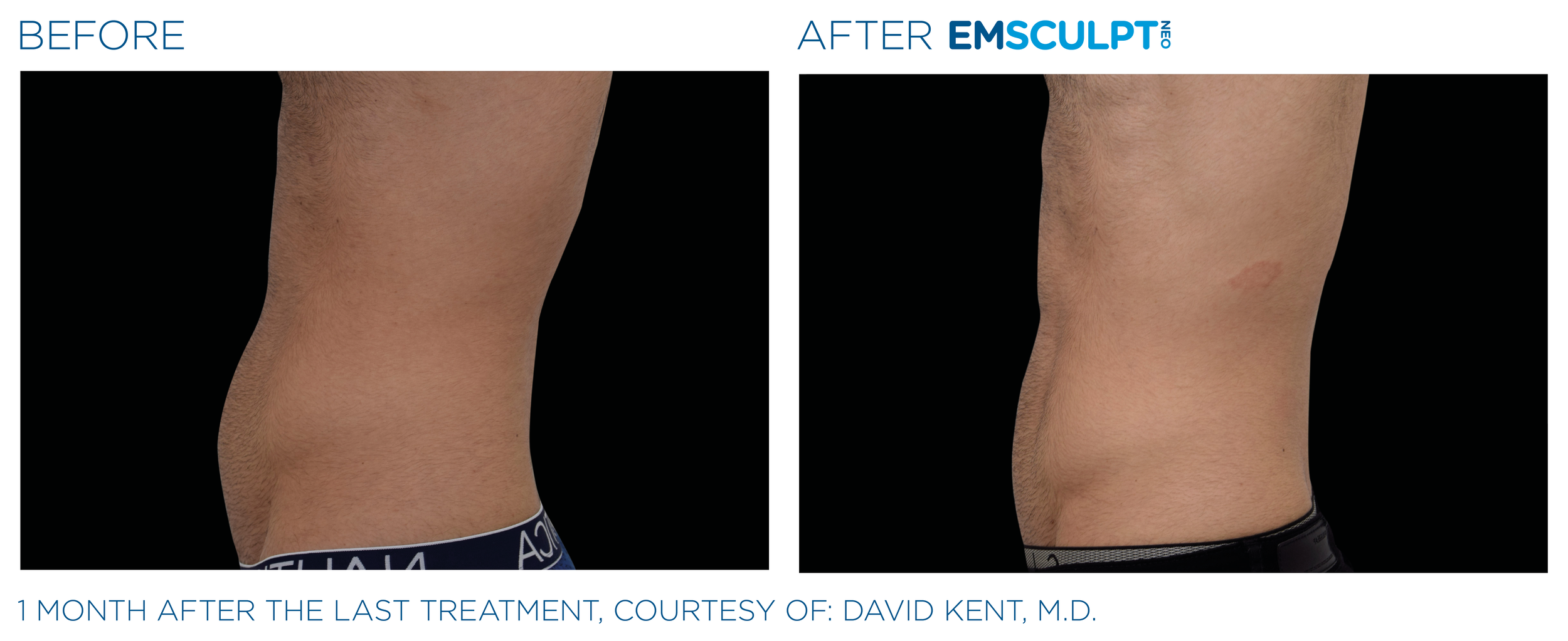 Emsculpt_neo_PIC_Ba-card-male-abdomen-021_ENUS100.png