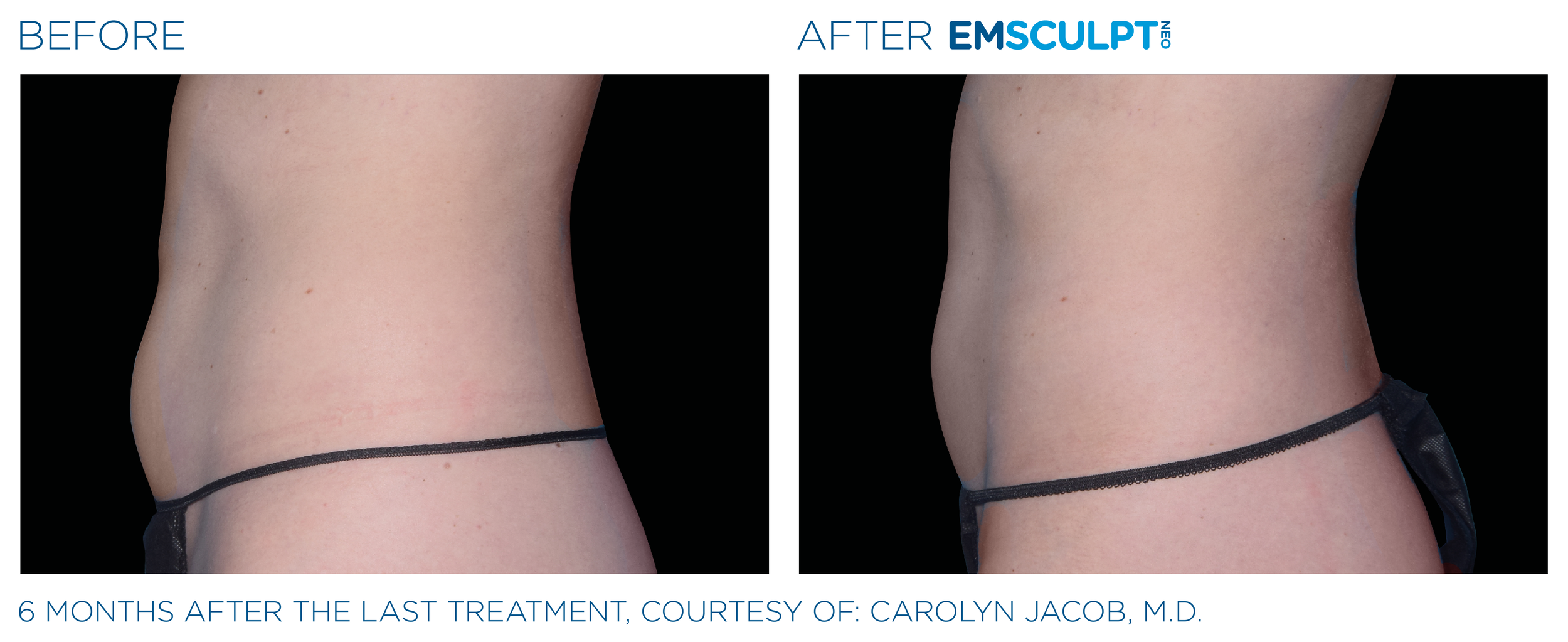 Emsculpt_neo_PIC_Ba-card-female-abdomen-041_ENUS100.png