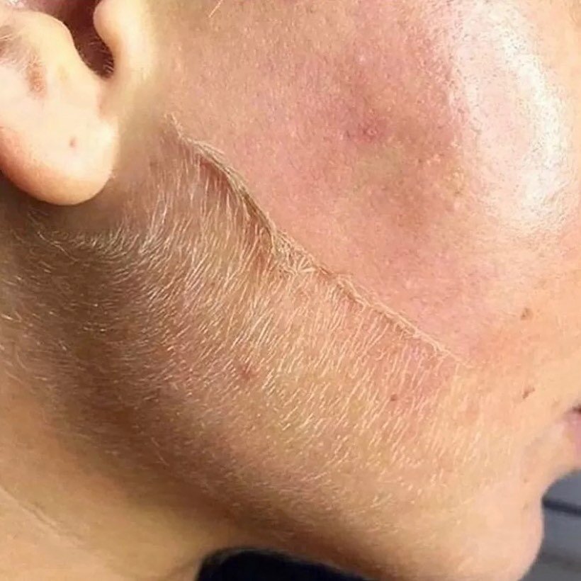 So you have some peach fuzz...
&mdash;&mdash;&mdash;&mdash;&mdash;&mdash;&mdash;&mdash;&mdash;&mdash;&mdash;&mdash;&mdash;&mdash;&mdash;&mdash;-
Peach fuzz can not be treated with laser therapy but perhaps we have an alternative solution. Dermaplanin