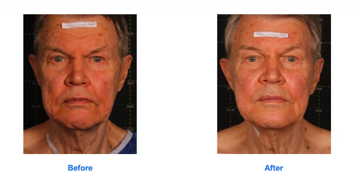 Dermasound Ultrasound Skin Tightening — Midwest Laser Centre