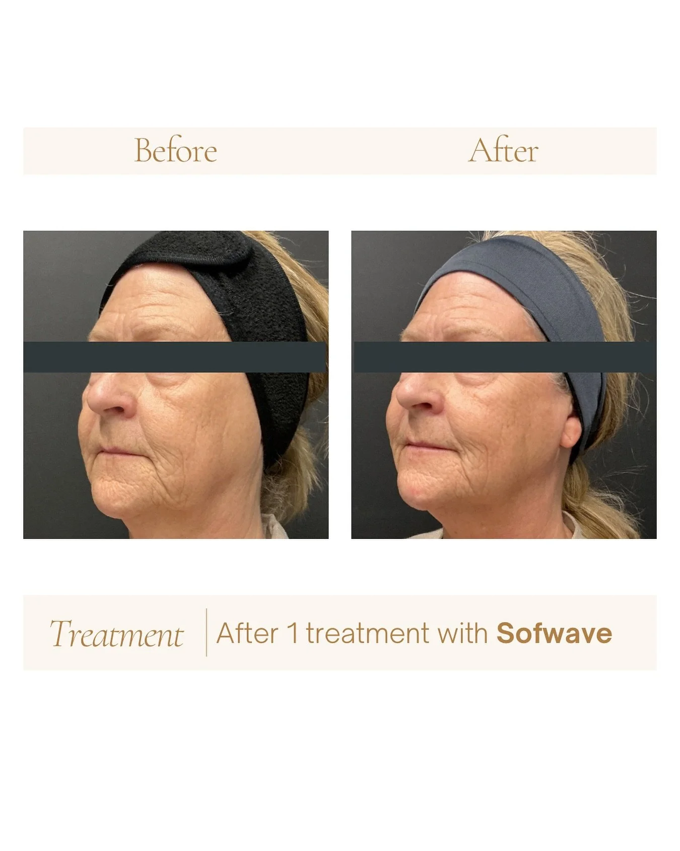 Rewind the clock with Sofwave! Aging skin loses elastin and collagen, but Sofwave boosts production for a lifted, supported look. This patient is getting their 2nd treatment to take their results to the next level. Sofwave is a game-changer for natur