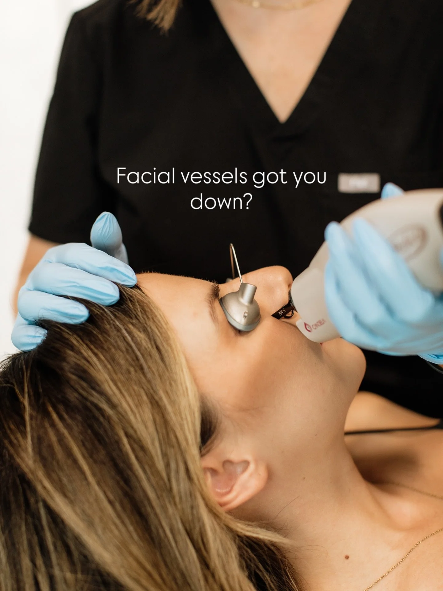 Do you have facial vessels that you would like to see gone? We can treat those! Midwest Laser Centre has offered the Vbeam Perfecta, a pulse dye laser that specializes in vessels and angiomas.