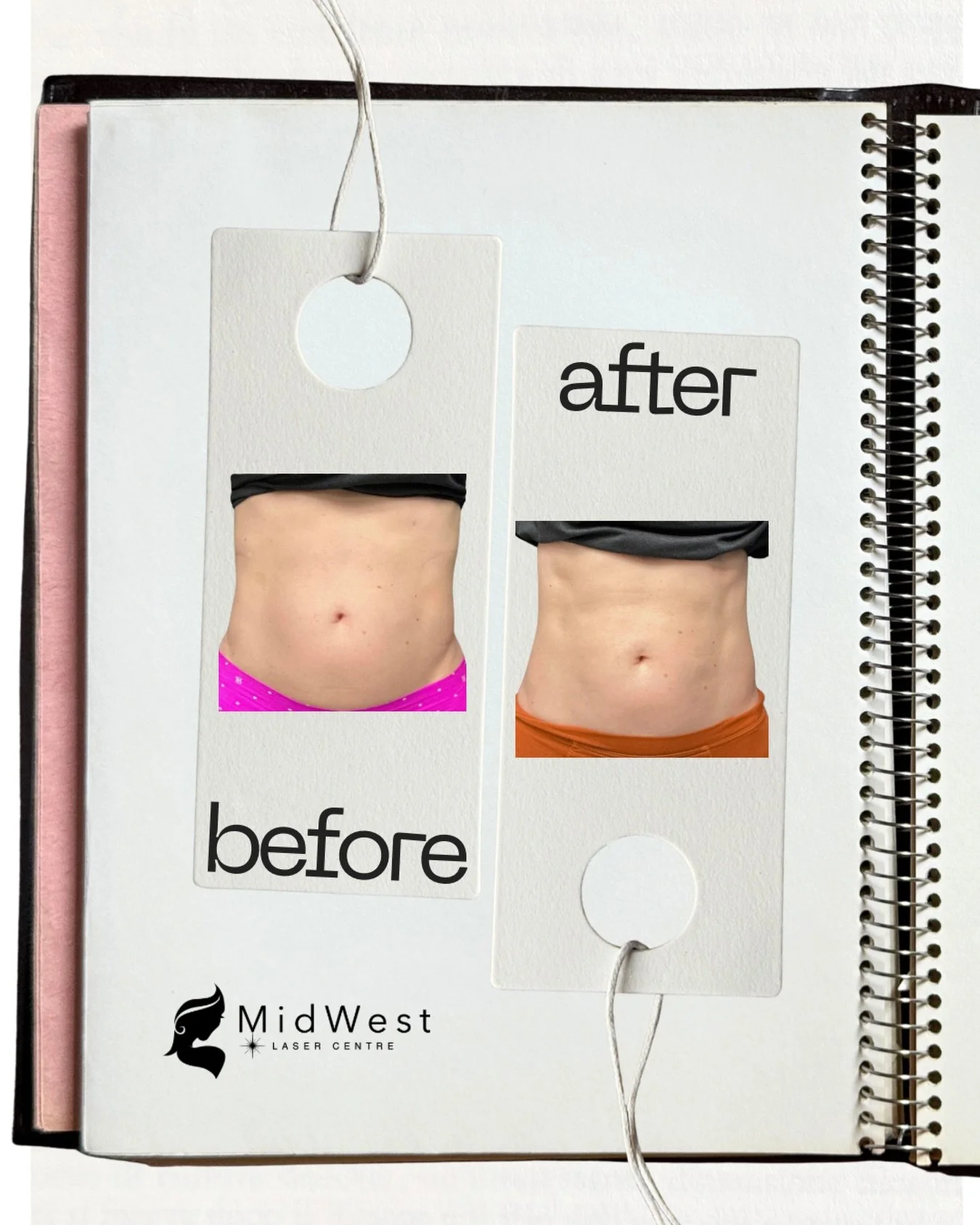 These incredible before and after results of 6 Emsculpt Neo sessions on abdomen and flanks! 💪

🔹 Peak Transformation: Notice the peak results at the 2-3 month mark, but the benefits keep coming. Feel stronger and more confident with a powerful core