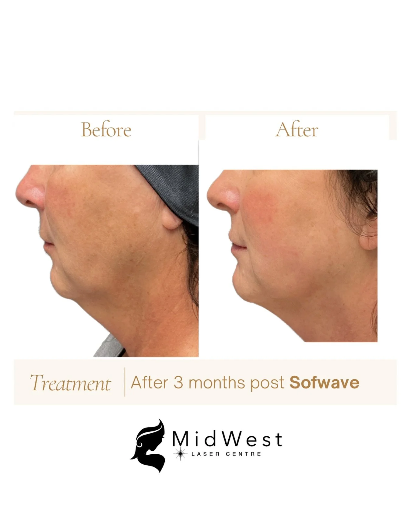 ✨ Experience a naturally lifted neck, jawline, and cheeks with no surgery and no downtime. 

How does it work? Sofwave uses advanced ultrasound technology to stimulate collagen production, rejuvenating your skin from within. Turn back the clock effor