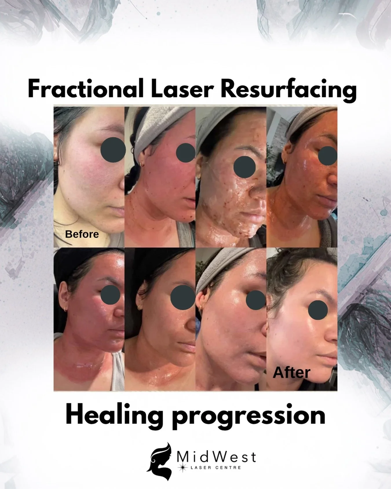 Incredible fractional laser resurfacing results! This patient chronicled their journey, showcasing before and after photos along with the healing process. Worth the temporary downtime!
Book for a free consultation today. 
.
.
#fractionalresurfacing #
