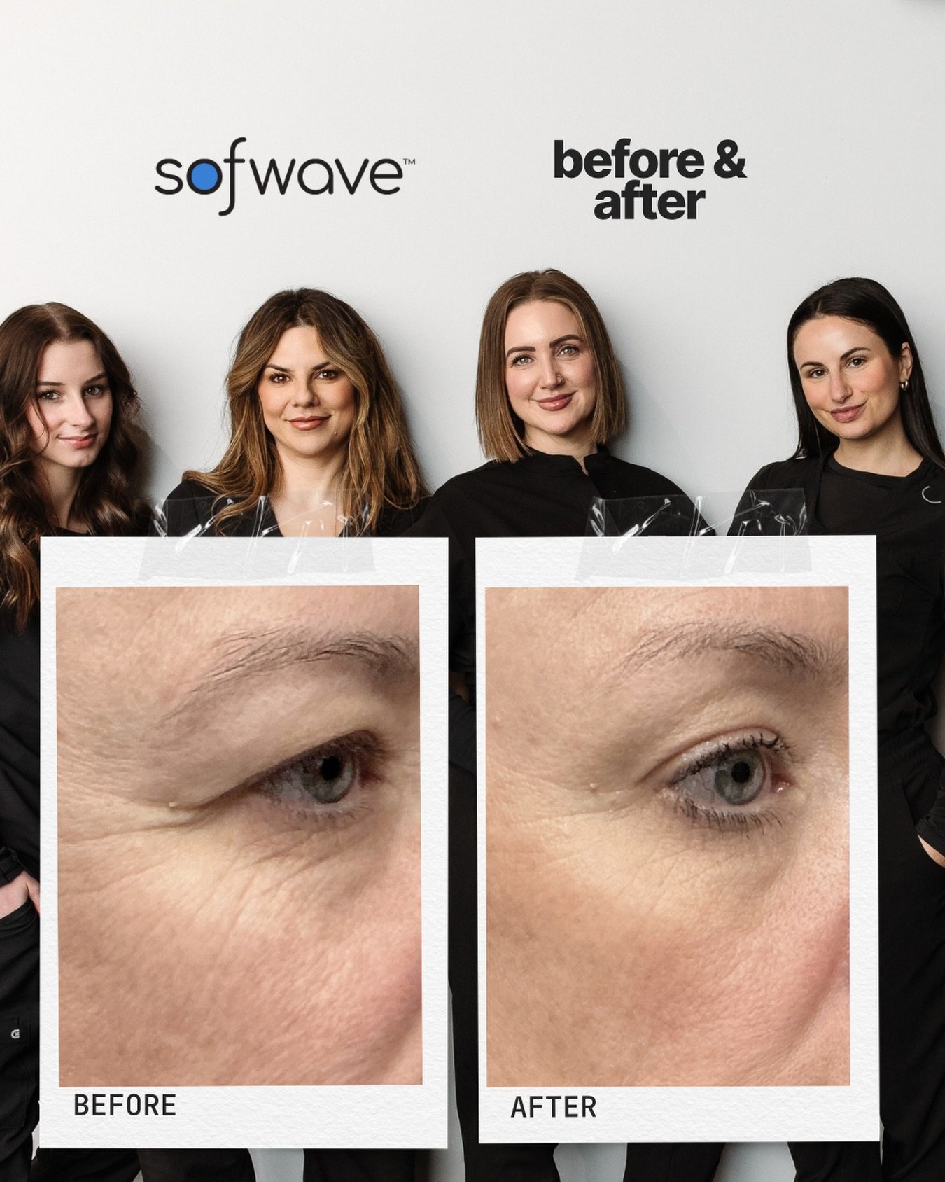 Sofwave. Results. Eyes. Wow.
We are just as speechless as you. 
Looking for a non-invasive way to improve laxity concerns without downtime or surgery? Give us a call for a free consultation. 
.
.
#sofwave #skintighteningtreatment #eyelid #yxemedspa #